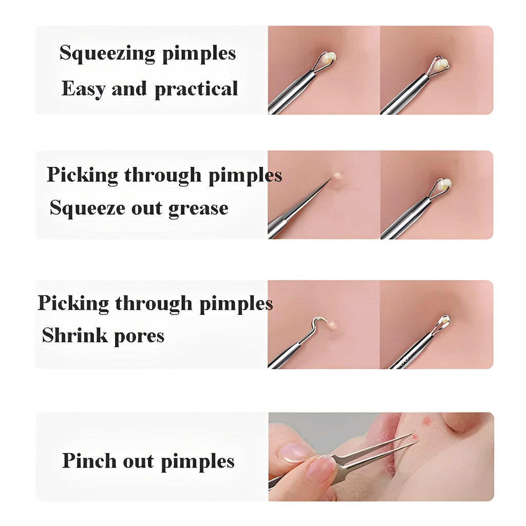 Blackhead Remover Tool Kit - Professional Stainless Steel Pimple Extractor Set